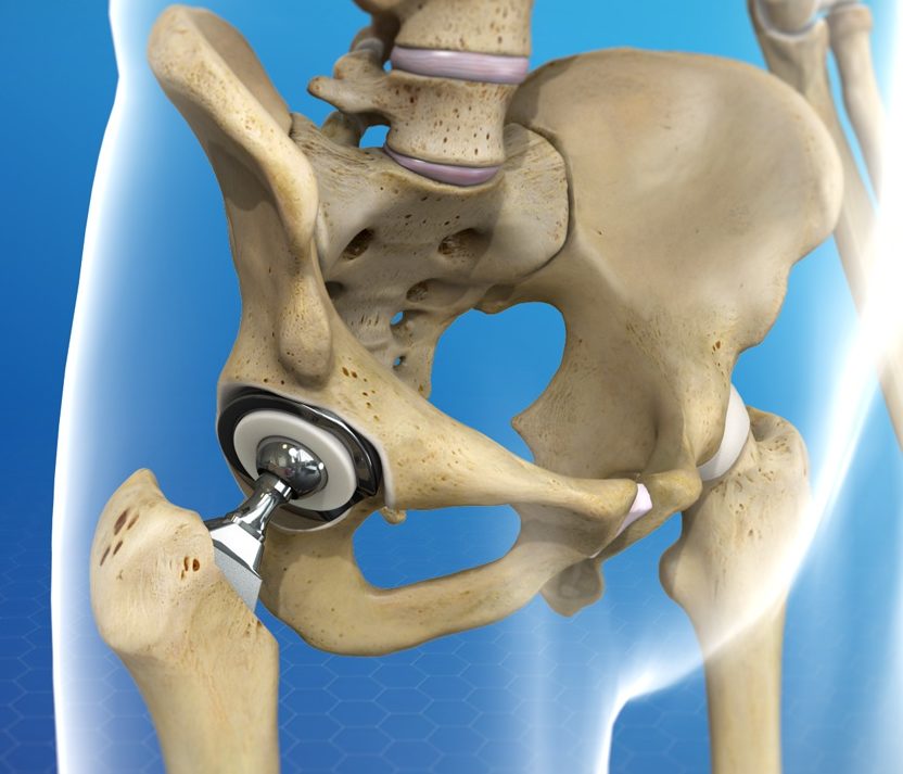 artroplastia prótese total do quadril dr joão rodolfo radtke